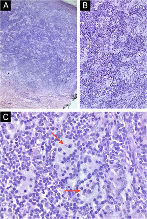 Histopathology of a lesion on the back, stained with Hematoxylin & eosin. (A) Well-defined dermal lymphohistiocytic proliferation without epidermal involvement (Hematoxylin & eosin, ×40). (B) Numerous histiocytes with broad amphophilic cytoplasm interspersed with small lymphocytes (Hematoxylin & eosin, ×100). (C) Presence of emperipolesis demonstrated by the red arrows (Hematoxylin & eosin, ×400).