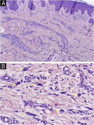 Histological images. (A) Low magnification view showing proliferation of thickened capillaries and small venules within a collagenous fibrotic stroma in the superficial and mid dermis (Hematoxylin & eosin, ×100). (B) Higher magnification picture showing the multinucleate cells (yellow arrows) (Hematoxylin & eosin, ×400).