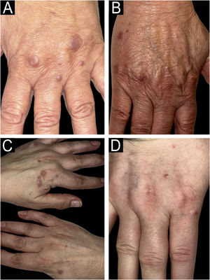 Clinical images. Small flat violaceous or brownish papules clustered on the dorsal aspect of the hands.