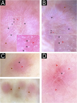 Dermoscopic images. Observed structures include homogeneous brown periphery (*), vascular dots (>), rosettes (→), shiny white lines (=), and whitish reticulated pattern (×). Pink, brown, and/or whitish diffuse areas were observed in all cases, with some lesions showing a homogeneous brown periphery (*). Regular vascular dots (>) were seen in all cases. Panels A and B highlighted multiple rosettes with a consistent distribution and orientation, whereas panel C revealed a single rosette at the lesion