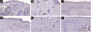 B (CD20+) cells in tuberculoid leprosy arranged around granulomas (A) and cells immunolabeled with the MZB1 antibody (D). Presence of rare perivascular B-cells (B) and absence of MZB1 expression (E) in indeterminate leprosy. In lepromatous leprosy, note rare clusters of B-cells within the diffuse macrophage infiltrate (C) and rare cells immunolabeled with the MZB1 antibody, some of them with plasma cell morphology (inset) (F). Immunohistochemical technique, diaminobenzidine chromogen, and counterstaining with hematoxylin. Scale bars (left top) indicate the magnification.