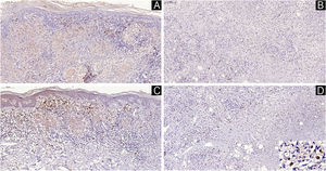 In type 1 reaction, B (CD20+) cells are present in the papillary dermis and around epithelioid granuloma in the reticular dermis (A). Cells immunolabeled with the MZB1 antibody are observed in the papillary dermis; however, they are absent around the granuloma (C). In type 2 reaction, rare B-cells amidst the regressive macrophage infiltrate (B) and a few clusters of cells immunolabeled with the MZB1 antibody, some of them with plasma cell morphology (inset) (D). Immunohistochemical technique, diaminobenzidine chromogen, and counterstaining with hematoxylin. Scale bars (left top) indicate the magnification.