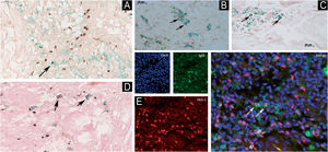 B1-cells (PAX5+/CD5+) in tuberculoid leprosy (A); Be1-cell (CD20+/Tbet+) in type 1 reaction (B); Breg cell (CD20+/c-MAF+) in type 1 reaction (C); B1 and MZB cells (PAX5+/MZB1+) in tuberculoid leprosy (D), double immunolabeling technique using diaminobenzidine chromogen (brown) for PAX5 and T-bet and PermaGreen (green) for CD20 antibody; B1-cell (PAX5+/IgM+) in laser confocal microscopy in type 1 reaction (E). Arrows indicate the respective cells. Scale bars – indicate the magnification.