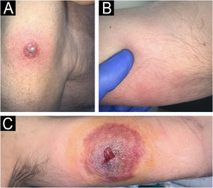 New skin lesions secondary to pathergy. (A) Erythematous violaceous plaque on the left shoulder around vaccine application. (B) Subcutaneous nodule on the medial aspect of the right arm in the area of support. (C) Ulcer resembling pyoderma gangrenosum on the inner side of the left arm in the peripheral route. Histopathology of the left shoulder lesion showed histiocytoid sweet syndrome.