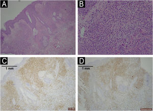 Histopathology of a shoulder lesion (panel A Haematoxylin-Eosin 40×; panel B Haematoxylin-Eosin 200×; panel C CD68 40×; panel D MPO 40×). A dermal infiltrate was rich in atypical cells of histiocytic habitus, arranged in clusters and infiltrating collagen bundles (panel A‒B). Immunohistochemistry showed that the cells combined myeloid and monocytic immunophenotypes, with expression of both CD68 (panel C) and MPO (panel D). Lymphoid markers (CD3, CD79a, CD63 and PAX5) were negative. CD34, CD56, CD117 and CD138 were also negative.
