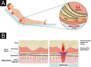 (A) Actions of pressure, friction, and shear over the bony prominence. (B) External pressure and compression of capillaries (from surfaces such as a bed or chair) interfere with local blood flow and, consequently, tissue perfusion, leading to the development of pressure injury. Source: Authors own.