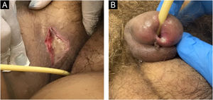 (A) Medical device-related pressure injury in a patient with a pressure injury on the inner surface of the right thigh caused by pressure from an indwelling urinary catheter. (B) Urethral mucosal pressure injury in a patient with an indwelling urinary catheter. Source: Authors