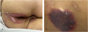 Differential diagnosis of pressure injury. (A) Incontinence-associated dermatitis in a patient with urinary and fecal incontinence who developed intense erythema in the regions intergluteal, perianal and scrotum. (B) Kennedy’s terminal ulcer in a patient with multiple organ failure who rapidly developed (within 24 hours) a purpuric plaque in the sacral region.