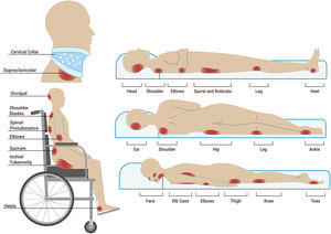 Main bony prominences at risk of developing pressure injuries according to dorsal, lateral, supine, and sitting positions, as well as those related to invasive devices. Sources: Authors