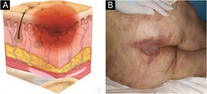 (A) Stage 1 pressure injury. Source with permission of the National Pressure Injury Advisory Panel. (B) Patient with non-blanchable erythema in the sacral region. Source: Authors