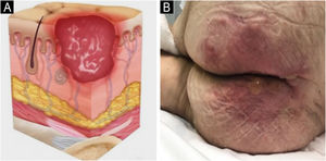 (A) Stage 2 pressure injury. Source with permission of the National Pressure Injury Advisory Panel. (B) Patient with partial-thickness skin loss and an intact blister in the gluteal region. Source: Authors
