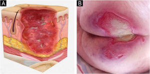 (A) Stage 3 pressure injury. Source with permission of the National Pressure Injury Advisory Panel. (B) Patient with full-thickness dermal loss in the gluteal region and the presence of slough. Source: Authors