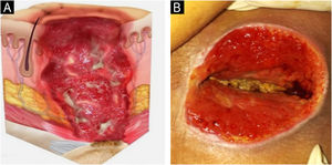 (A) Stage 4 pressure injury. Source with permission of the National Pressure Injury Advisory Panel. (B) Patient with full-thickness skin loss in the sacral region and exposure bone. Source: Authors