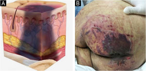 (A) Deep tissue pressure injury. Source with permission of the National Pressure Injury Advisory Panel. (B) Patient with extensive purpuric lesion in the gluteal region. Source: Authors