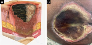 (A) Unstageable pressure injury. Source with permission of the National Pressure Injury Advisory Panel. (B) Patient with liquefactive necrosis and an area of coagulative necrosis in the sacral region, making it impossible to assess the depth of the pressure injury. Source: Authors