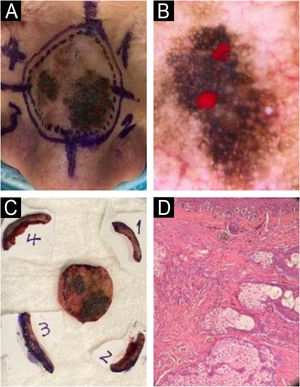 (A) Pre-operative clinical image of the dorsum nasi LM. (B) In vivo derm dotting image showing suspicious areas for invasive components on dermoscopy marked with red nail polish. (C) Tumor debulking of the central LM and four perimeter quadrants of 5 mm guided by dermoscopy. (D) Histopathology: Extensive involvement of melanoma in situ and a microinvasive focus of 0.42 mm Breslow (Hematoxylin & eosin, 10×, paraffin-embedded permanent sections).
