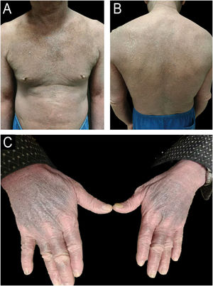 (A‒B) The patient presented to our hospital with generalized erythema, hyperpigmentation and scaling over the entire body. (C) Symmetrical flat-topped violaceous papules were observed on the dorsal hands.