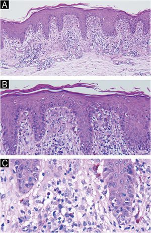 (A‒C) Histopathology revealed epidermal parakeratosis, acanthosis, scattered necrotic keratinocytes and basilar vacuolar change. A band-like infiltrate of lymphocytes, histiocytes, melanophages, eosinophils, and neutrophils was present at the dermoepidermal junction. (A, Hematoxylin & eosin ×10; B, Hematoxylin & eosin ×20; C, Hematoxylin & eosin ×40).
