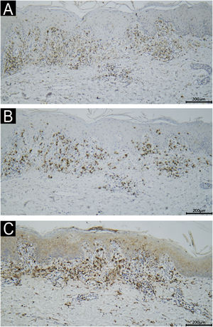 Immunohistochemical staining demonstrated that the lymphocytes stained positive for CD4 (A, ×10) and CD8 (B, ×10), with a CD4/CD8 ratio of approximately 3:2. The histiocytes stained positive for CD68 (C, ×10).