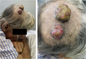 Scalp tumor lesions: Both were well-adhered, firm, friable, and painless. The larger lesion was formed by contiguous metastases of renal cell carcinoma and intestinal adenocarcinoma; the smaller lesion was formed solely by renal cell carcinoma cells.