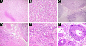 Histopathology of the largest lesion on the scalp. (A) Neoplasm formed by clear cells with an area of geographic necrosis. (B) Clear cells with pleomorphic nuclei permeated by prominent vascularization. (C) Under the clear cell carcinoma, neoplasm with a tubular pattern. (D) Area of angiolymphatic embolization between the two neoplasms. (E‒F) Adenocarcinoma with nuclear pleomorphism and atypical mitotic activity.