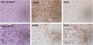 Different immunohistochemical expression profile between the two neoplasms, with positivity for CD10 and PAX8 in the clear cell carcinoma, and for SATB2 and CK20 in the adenocarcinoma.