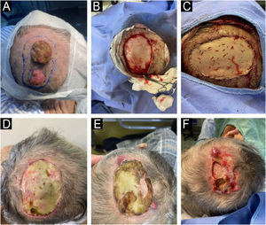 (A) Preoperative planning of excised lesions. (B) Intraoperative view showing en bloc resection of lesions. (C) Immediate postoperative result with wound closure using full-thickness skin graft. (D‒F) Late postoperative evolution, showing the emergence of new metastatic implants at the graft edge.