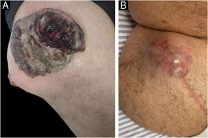 Tumor mass respectively: (A) on the day of admission and (B) recurrence 68 days after surgery.