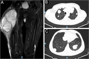 (A) Pre-surgery MRI of the thigh showing an expansile mass in the region of the extensor muscles measuring approximately 23.3 by 12.8 × 13.0 cm, with a volume of approximately 2000 mL, with a heterogeneous liquid content, areas suggestive of hemorrhage, and peripheral contrast uptake. (B and C) Contrast-enhanced chest computed tomography performed 68 days after complete excision of the lesion showed several pulmonary nodules with a neoplastic appearance.