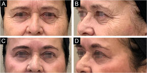 59-year-old patient, before (A and B) and after (C and D) 6 months of phenol-croton 35%/1.2% peeling for rejuvenation of the periocular region.