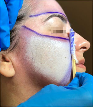 Uniform frosting that sets in quickly after applying phenol to the skin, resulting from the denaturation and coagulation of the proteins in the epidermal keratin and the superficial layers of the dermis.