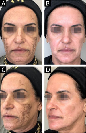 63-year-old patient with refractory melasma, before and after 6 months: A and B (frontal face); C and D (left hemiface), phenol-croton peeling 35%/1.2%.