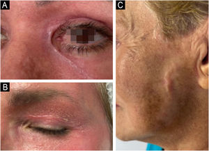 Hypertrophic scars after phenol-croton peeling in the eyelid region (A and B) and preauricular region (C). Photo: Dr. Felipe Ribeiro.