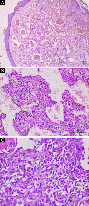 (A) Dilated vascular channels with a cavernous appearance, resembling a common hemangioma in the superficial portion of the biopsy. Magnification of ×40. (B) Observe vessels lined by endothelial cells whose nuclei are often protruding (hobnail), resembling a retiform hemangioendothelioma. Magnification of ×200. (C) Small vascular spaces surrounded by cells with scant cytoplasm and round and fusiform, hyperchromatic and irregular nuclei, suggestive of kaposiform hemangioendothelioma. Magnification of ×400. In (A), (B) and (C): Hematoxylin & eosin, Scale bar: 100μm.