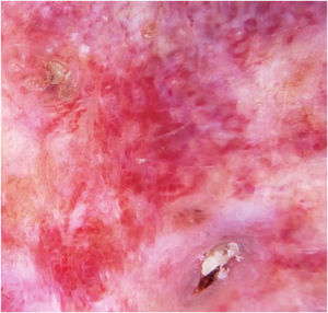 Dermoscopy image displays an erythematous base with ectatic red vessels, linear with a horizontal orientation and rounded, globular with a vertical orientation. Associated with some nests and blue-gray globules, rosettes, fibrosis, and areas resembling seborrheic keratosis.