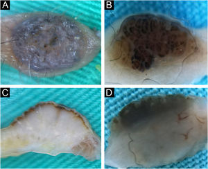 Intradermal nevus. Horizontal ex vivo dermoscopy. Presentation as (A) dark blue homogeneous pigmentation. (B) Cobblestone global presentation. Vertical ex vivo dermoscopy. (C) Pigmentation in the form of a thin brown line extending above the whitish body with an indistinct lower border. (D) Pigmentation through the entire thickness of the nevus.