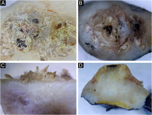 (A‒C) Seborrheic keratosis, hyperkeratotic type. (B‒D) Invasive squamous cell carcinoma. Horizontal ex vivo dermoscopy. (A‒B) Visibility of whitish structures, crusts, yellowish scales. Vertical ex vivo dermoscopy. (B) Involvement of the epidermis alone, in the form of whitish hyperkeratosis of an irregular surface, with normal dermis. (D) Hyperkeratosis of the epidermis under which there is a whitish tumor body infiltrating the dermis and the subcutaneous fat.