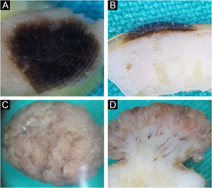 Intradermal nevus. Horizontal ex vivo dermoscopy. (A) homogeneous global pattern. (C) cobblestone global pattern. Vertical ex vivo dermoscopy. (B) dark pigmentation in the form of a slightly curved line, without clear boundaries of the nevus body. (D) mushroom-shaped tumor, pigmentation of the upper third in the form of a strip of wavy surface with vascularized whitish body.