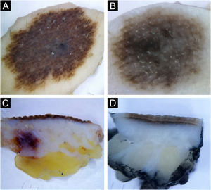 Epidermo-dermal nevus. Horizontal ex vivo dermoscopy. (A) globular global pattern. (B) parallel furrow pattern (acral nevus). Vertical ex vivo dermoscopy. (C‒D) linear pigmentation of different length, thickness, and color.