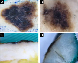 Dysplastic nevus. Horizontal ex vivo dermoscopy. (A‒B) Predominance of darkly pigmented homogeneous global pattern with conspicuous presence of one or more dermoscopic features of melanoma. Vertical ex vivo dermoscopy. (C‒D) Superficial, thin, linear dark pigmentation.