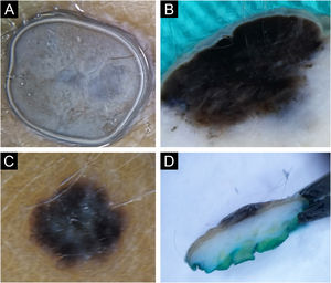 Blue (A‒B) and Reed (C‒D) nevus. Horizontal ex vivo dermoscopy. (A) Homogeneous blue global presentation. (C) Homogeneous global pattern, asymmetric shape, irregular edges, and blue-whitish veil in the central part. Vertical ex vivo dermoscopy. (B) Visible deep, homogeneous, dark pigmentation with an irregular lower margin. (D) Linear, superficial dark pigmentation.