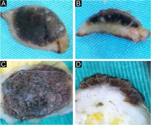 Seborrheic keratosis, acanthotic type (A‒B) and irritated (C‒D). Horizontal ex vivo dermoscopy. (A) Milia-like cysts, clear demarcation, homogeneous pigment background. (C) Pronounced hyperkeratosis and papillomatous surface. Vertical ex vivo dermoscopy. (B) Thickened epidermis, milia-like cysts, dark pigmentation filling the epidermis. (D) Absence of milia-like cysts, brown, thickened wavy epidermis.