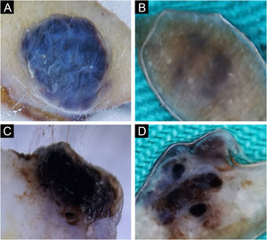 Angioma. Horizontal ex vivo dermoscopy. (A) Typical presentation as homogeneous dark blue pigmentation. (B) Atypical presentation as asymmetric, homogeneous light blue pigmentation. Vertical ex vivo dermoscopy. (C) Deep homogeneous indigo-black pigmentation, irregular in shape. (D) Typical lacunae and deep homogeneous indigo dark background.