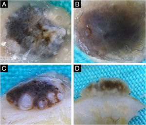 Irritated seborrheic keratosis. Horizontal ex vivo dermoscopy. (A) Whitish fields, blue-white veil, asymmetry of color and shape. (B) Non-specific blue-brown pigmentation. Vertical ex vivo dermoscopy. (C‒D) Epidermal involvement, striking milia-like cysts, clear regular margins.