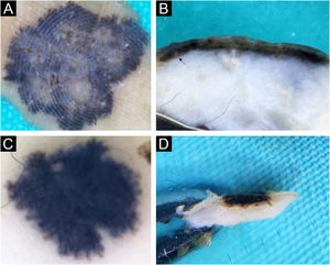 (A‒B) Seborrheic keratosis, acanthotic type. (C‒D) Dysplastic nevus. Horizontal ex vivo dermoscopy. (A‒C) Numerous pseudopods along the periphery of the tumor with indigo blue pigmentation interspersed with whitish structures. Vertical ex vivo dermoscopy. (B) Lesion confined to the epidermis, pigmentation in the form of a line with a regular lower margin and the presence of one milia-like cyst (arrow). (D) Superficial, dark homogeneous linear pigmentation with tiny islands of pigmentation protruding from the lower margin.