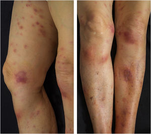 Erythematous and painful nodules affecting the entire length of the lower limbs.