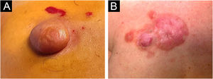 Clinical presentation of dermatofibrosarcoma protuberans. (A) Solitary, firm, dome-shaped nodule with a smooth surface. (B) Irregular, violaceous plaque with multiple nodular components.