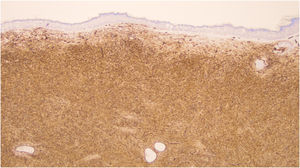Immunohistochemical staining for CD34 showing strong and diffuse positivity in tumor cells (×40).