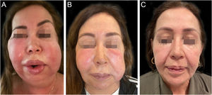 Adverse reaction to dermal filler. (A and B) Facial edema, erythema, and subcutaneous nodules in the cheeks, lips, and eyelids. (C) Patient at the one-year follow-up after starting treatment with adalimumab.