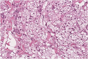 Granulomatous inflammation with lymphocytes and foamy histiocytes with abundant vacuoles (Histopathology with Hematoxylin & eosin; ×40).